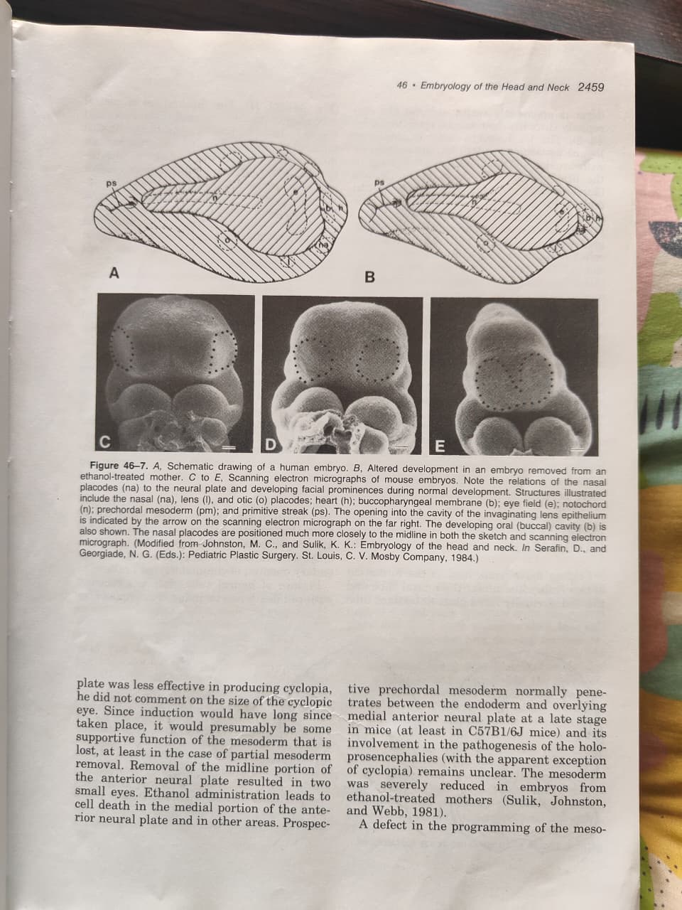 Figure 46-8 - Otocephaly